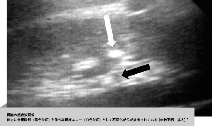 腎臓障害 全身性の症状 低ホスファターゼ症 Hpp の医学的リソース
